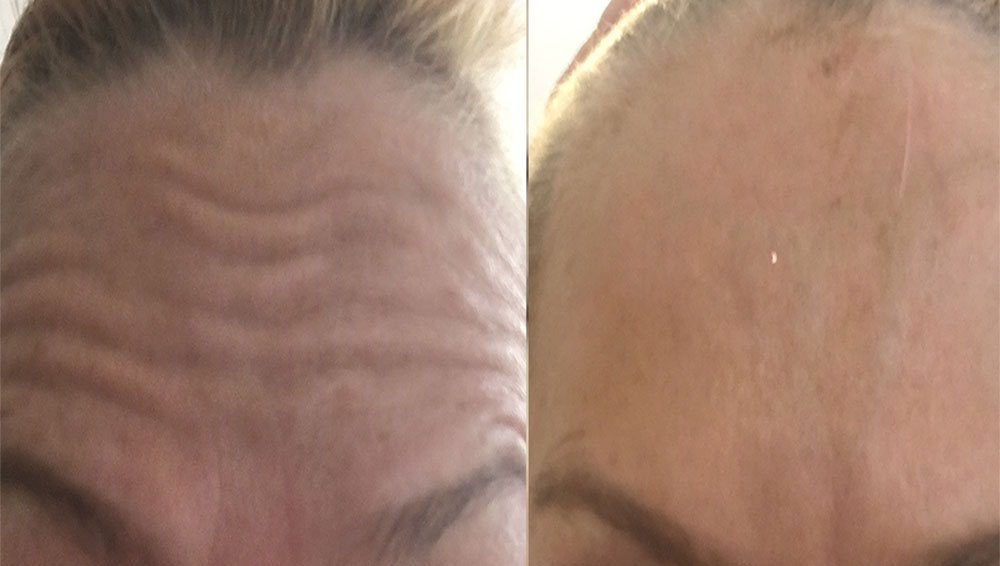 Anti Wrinkle F B and A