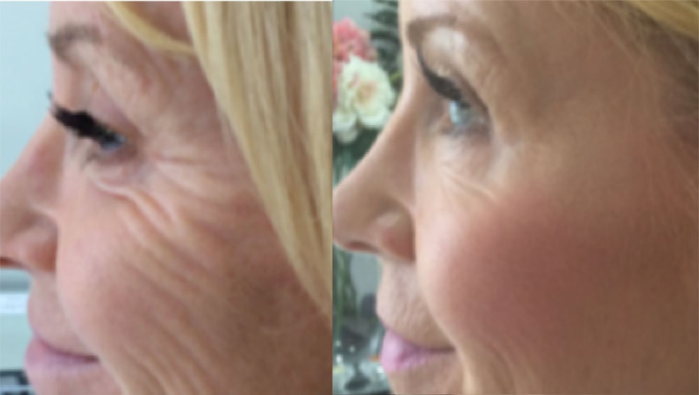 Anti wrinkle b and a