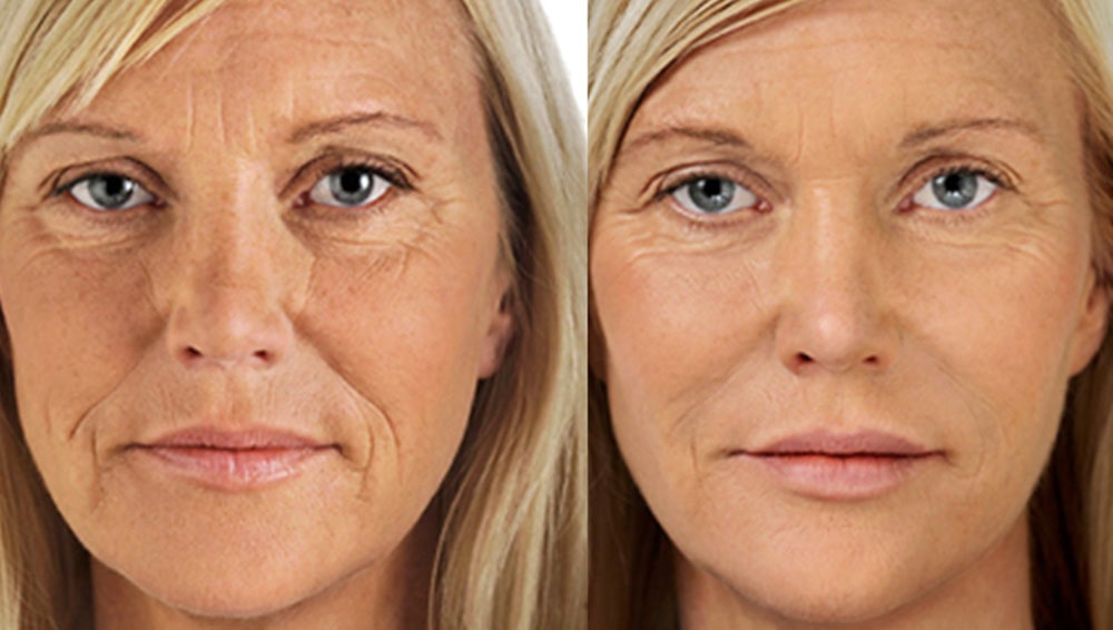 Dermal filler B and A