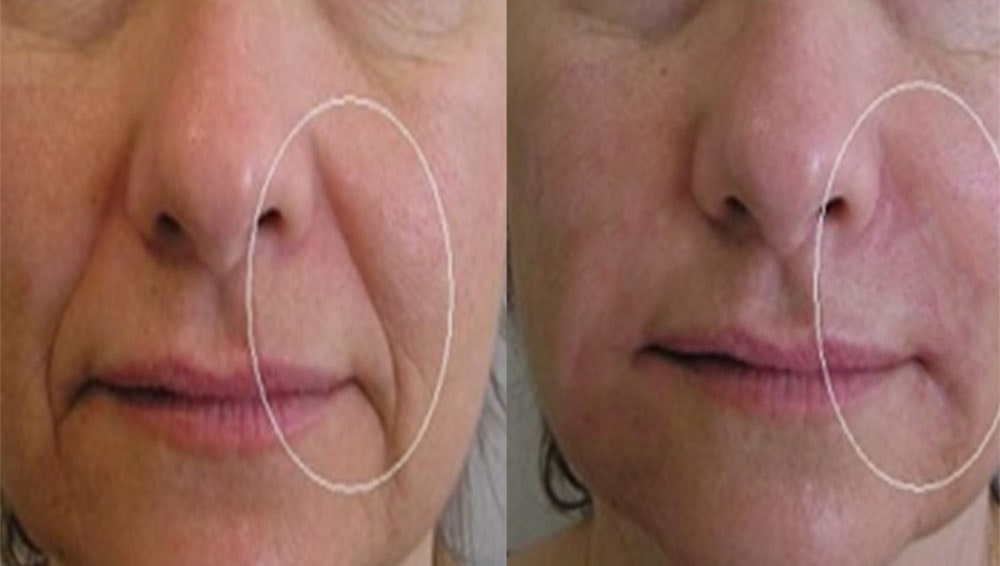 Dermal filler SL B and A