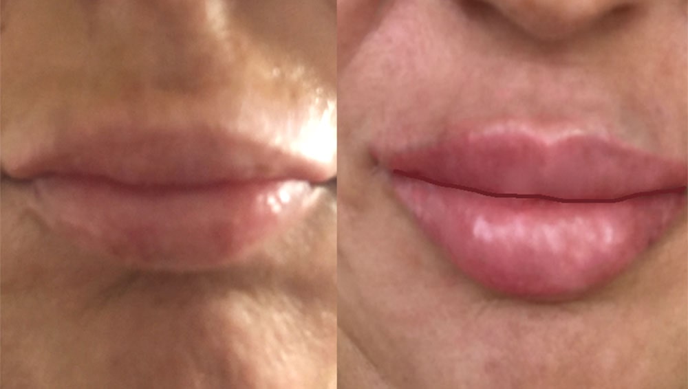 Lips B and A