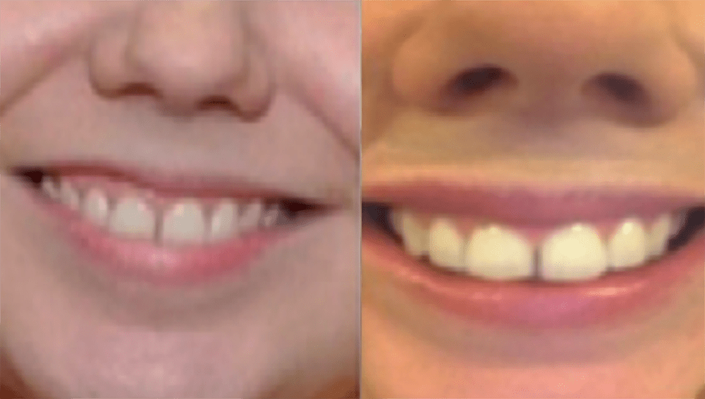 Lips smile B and A